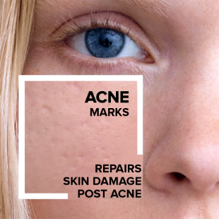 /acne-lrp?sort[by]=popularity&sort[dir]=desc